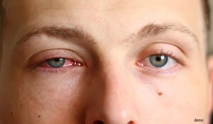 Conjunctivitis से अपनी आंखों की सुरक्षा करने के व्यावहारिक उपाय, जानिए कैसे रखें अपनी आंखो को स्वस्थ